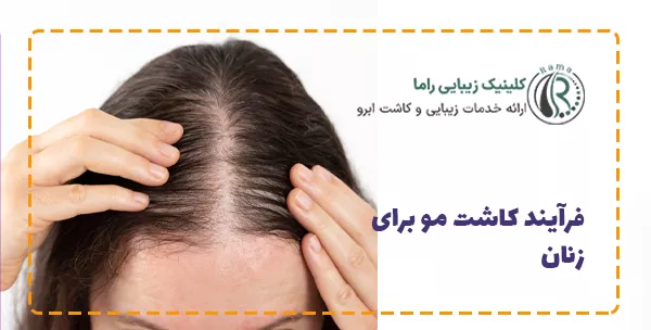 فرآیند کاشت مو برای زنان