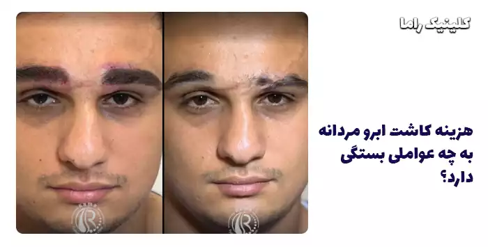 قیمت کاشت ابرو مردانه در تهران