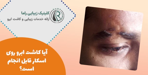 آیا کاشت ابرو روی اسکار قابل انجام است؟