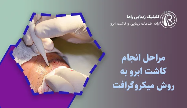 مراحل انجام کاشت ابرو به روش میکروگرافت