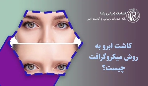 کاشت ابرو به روش میکروگرافت چیست؟