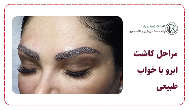 مراحل کاشت ابرو با خواب طبیعی