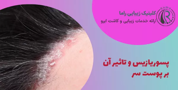 پسوریازیس و تاثیر آن بر پوست سر