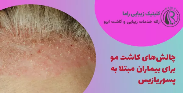 چالش‌های کاشت مو برای بیماران مبتلا به پسوریازیس