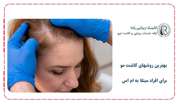 بهترین روشهای کاشت مو برای افراد مبتلا به ام اس
