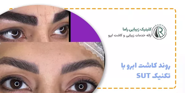 روند کاشت ابرو با تکنیک SUT
