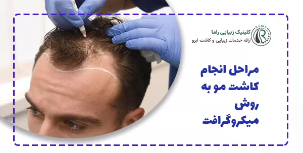 مراحل انجام کاشت مو به روش میکروگرافت