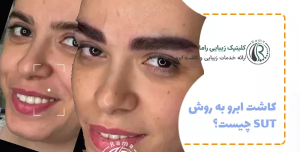 کاشت ابرو به روش SUT چیست؟