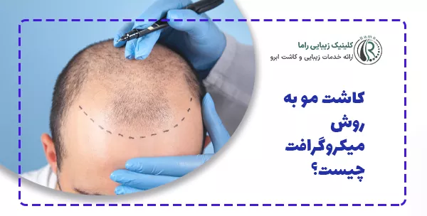 کاشت مو به روش میکروگرافت چیست؟