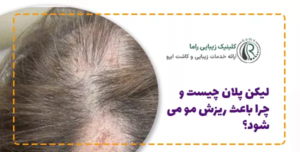 لیکن پلان چیست و چرا باعث ریزش مو می‌شود؟