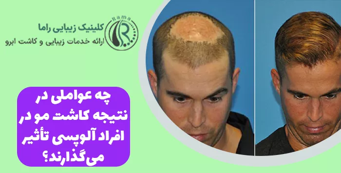 چه عواملی در نتیجه کاشت مو در افراد آلوپسی تأثیر می‌گذارند؟