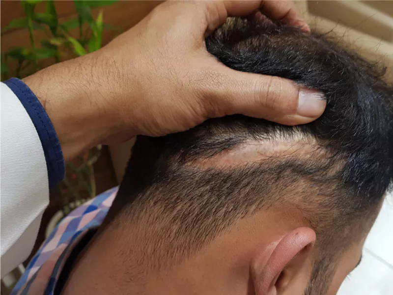 کاشت مو برای بیماران آلوپسی