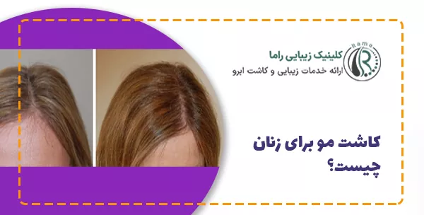 کاشت مو برای زنان چیست؟