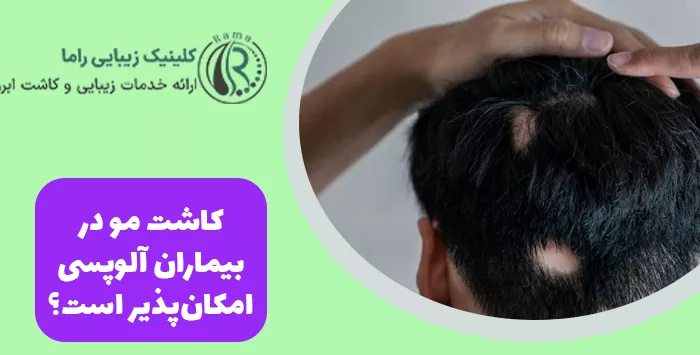 کاشت مو در بیماران آلوپسی امکان‌پذیر است؟
