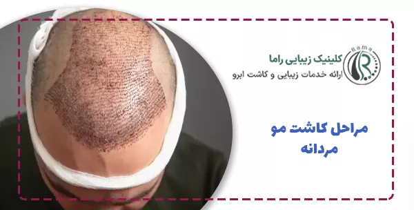 مراحل کاشت مو مردانه