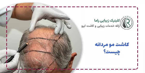 کاشت مو مردانه چیست؟