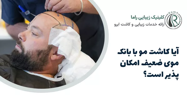آیا کاشت مو با بانک موی ضعیف امکان‌پذیر است؟