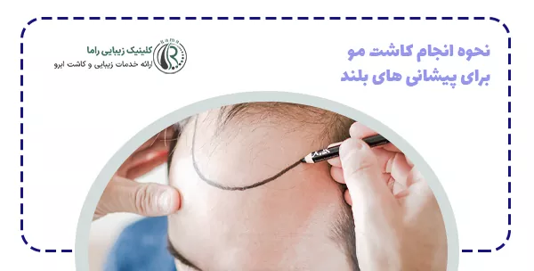 نحوه انجام کاشت مو برای پیشانی های بلند