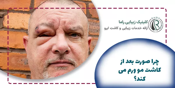 چرا صورت بعد از کاشت مو ورم می‌کند؟