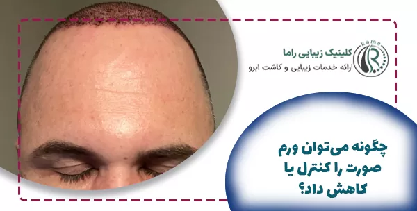 چگونه می‌توان ورم صورت  بعد کاشت را کنترل کرد؟