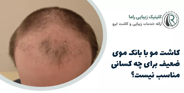 کاشت مو با بانک موی ضعیف برای چه کسانی مناسب نیست؟