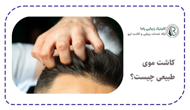 کاشت موی طبیعی چیست؟
