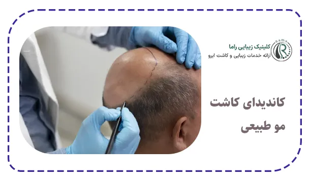 کاندیدای کاشت مو طبیعی
