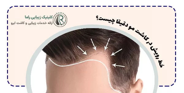 خط رویش در کاشت مو دقیقا چیست؟