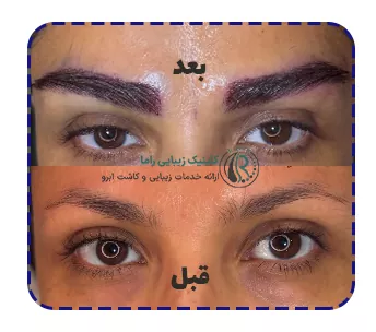 قبل و بعد از کاشت ابرو