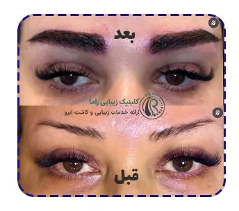 نمونه کار کاشت ابرو