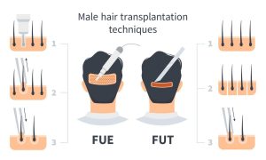 fut-vs-fit-hair-transplant
